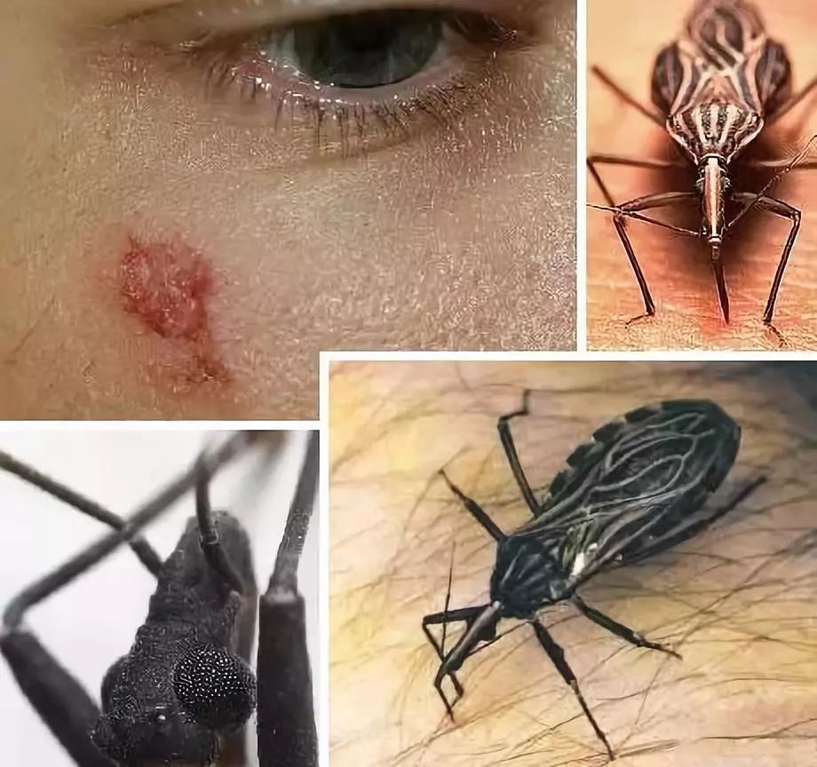 锥蝽虫吸血就传染艾滋病吗,锥蝽传染hiv吗