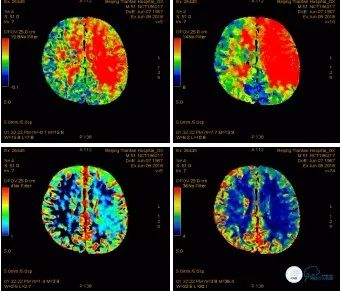 颈动脉闭塞介入治疗的风险,慢性动脉闭塞症病例