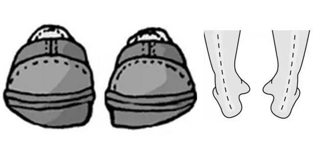 鞋后跟偏外侧磨损怎么办,脚后跟外侧鞋的位置磨损严重