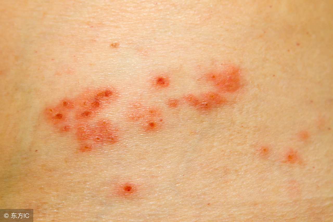 带状疱疹的后遗症症状及治疗方法,腰部带状疱疹种类及症状后遗症