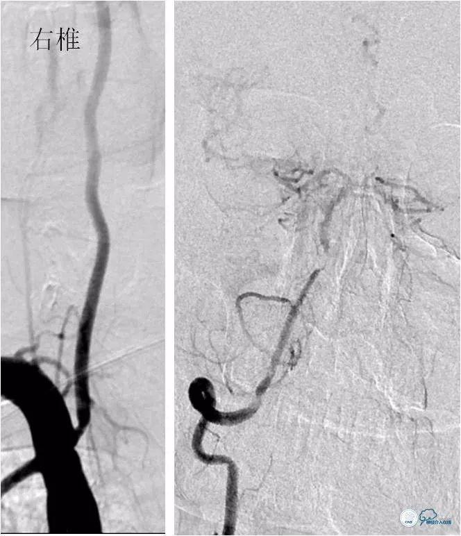 天坛周记｜左椎动脉开口及基底动脉串联狭窄血管内介入治疗1例