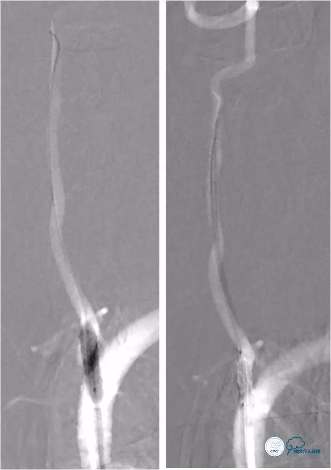 天坛周记｜左椎动脉开口及基底动脉串联狭窄血管内介入治疗1例