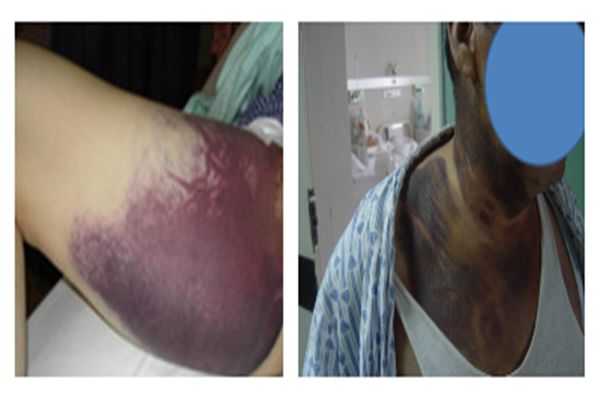 穿刺股动脉并发症,穿刺部位并发症预防及处理