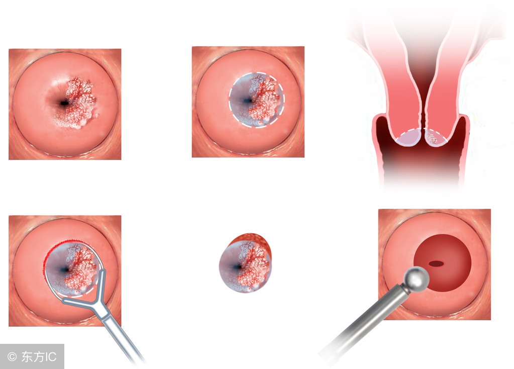 做了宫颈息肉手术后需要注意什么,做宫颈息肉手术后注意事项和禁忌
