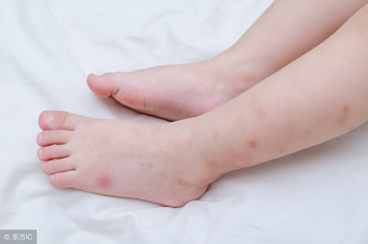 婴儿夏季防虫,夏天宝宝防叮咬