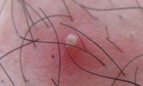 头皮顽固毛囊炎用什么洗头膏,头皮毛囊炎的症状和图片