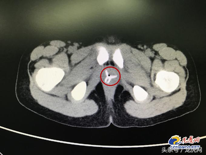 7岁女孩*体下**分泌物增多竟因一年前小伙伴塞进个吸盘（图）