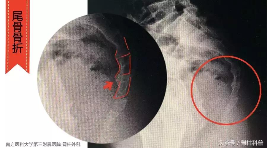 脊柱外科看腰痛怎么治疗,脊柱外科主任腰疼视频