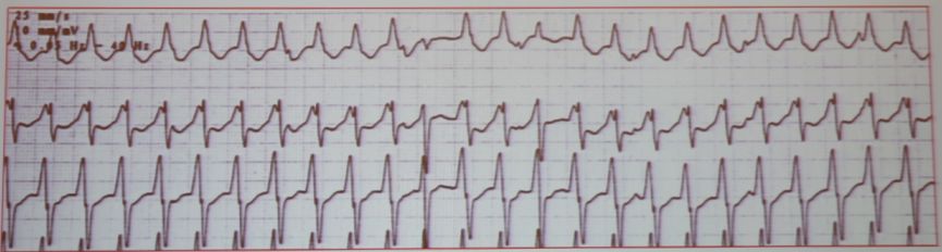 「CHC2018」郭继鸿：心电学进展2018