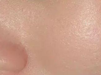 治疗毛孔粗大,激光治疗毛孔粗大多少钱