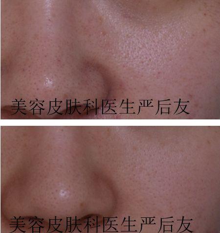 毛孔粗大如何治疗最好最快,如何治疗黑头和毛孔粗大