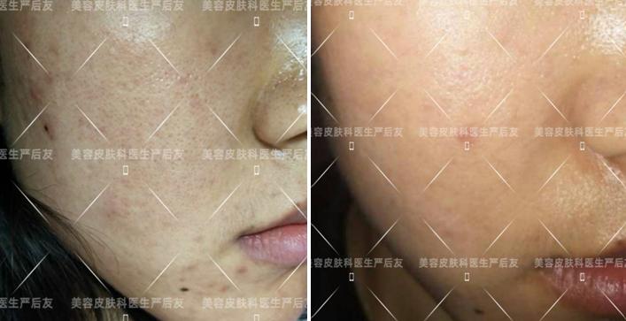 治疗毛孔粗大,激光治疗毛孔粗大多少钱