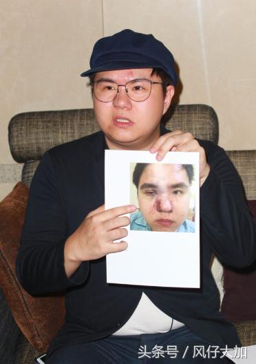 玻尿酸隆鼻的网红,因打玻尿酸毁容的男网红