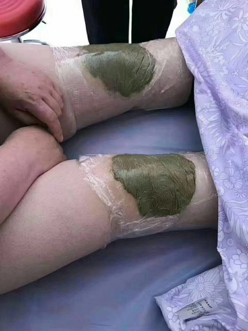 你还在“谈骨色变”吗？骨刺没你想的那么可怕