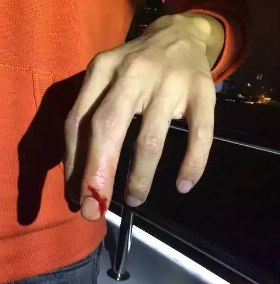 海鲜刺伤引起何菌感染,吃海鲜被刺感染怎么办