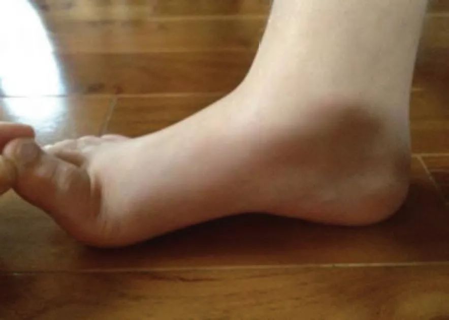 儿童轻微扁平足还需要穿矫正鞋吗,儿童扁平足x型腿如何矫正