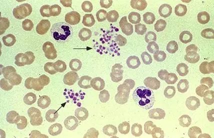 皮肤出现紫色瘀斑图片怎么治疗,手臂上出现瘀斑会有哪些疾病