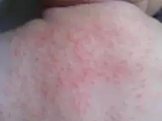 六个月宝宝湿疹皮肤破溃,宝宝起红疹破皮水泡