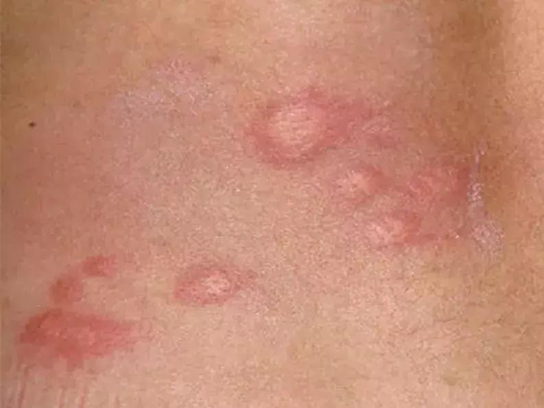 宝宝长小疹子后溃烂,宝宝的红疹子溃烂了