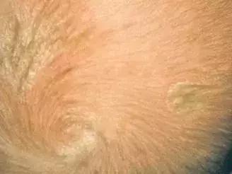 宝宝长小疹子后溃烂,宝宝的红疹子溃烂了