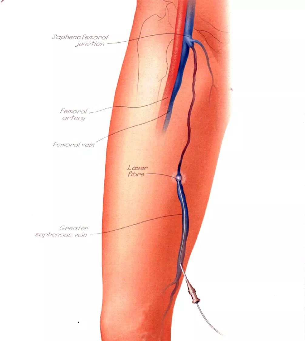 跷二郎腿有什么危害腿粗,跷二郎腿有什么危害图片