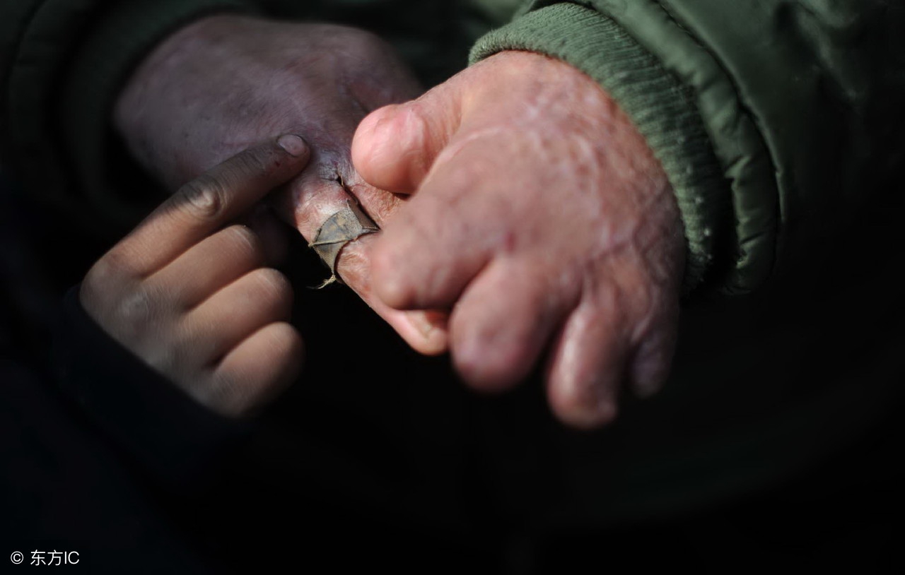 少年手脱皮能吃维生素ad软胶囊吗,孩子手脱皮是缺什么引起的