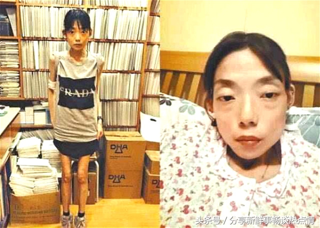 因为老公一句话得了厌食症怎么办,因老公一句话疯狂减肥