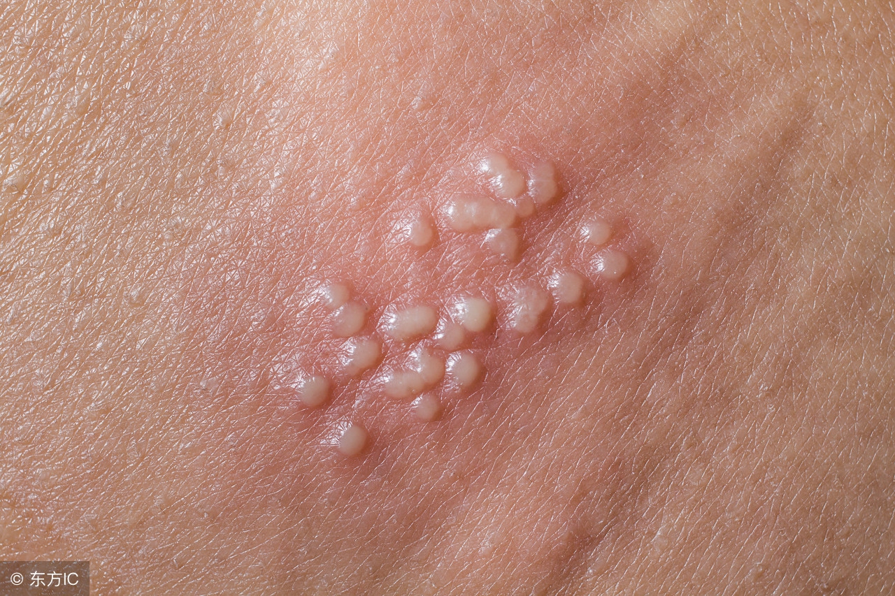 老人带状疱疹出院后还经常低烧,带状疱疹出现低烧是怎么回事