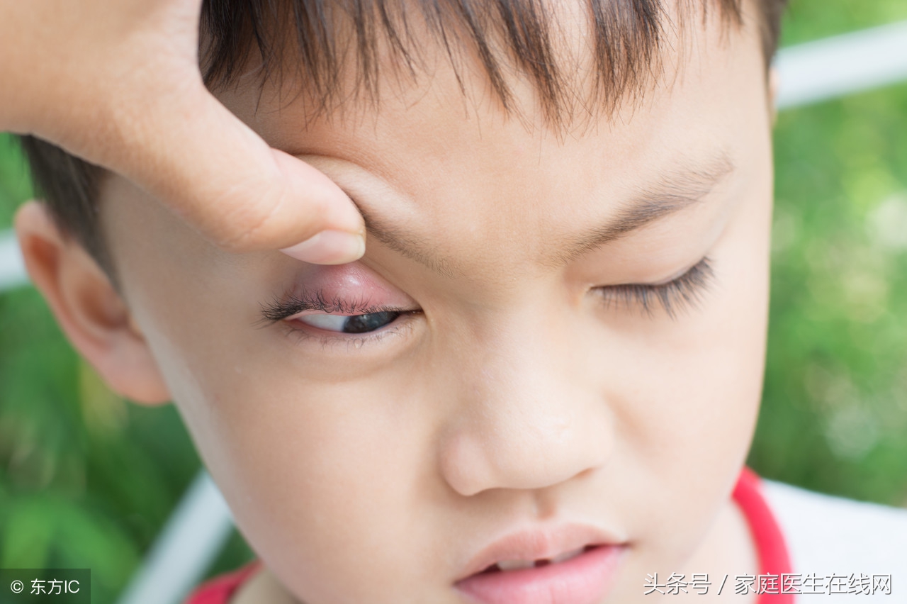 眼睛长麦粒肿针眼能用热毛巾敷吗,眼睛麦粒肿是老人常说的长针眼吗