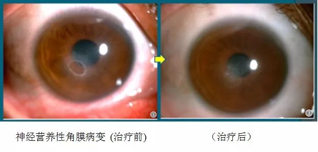 角膜上皮细胞损伤多久能恢复,治疗角膜上皮细胞损伤全国专家