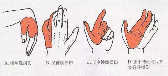 手麻要警惕病变,手麻肩膀痛警惕四种病