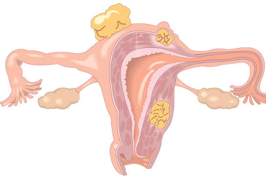 过度治疗宫颈糜烂,自己怎么确定自己是否有宫颈糜烂