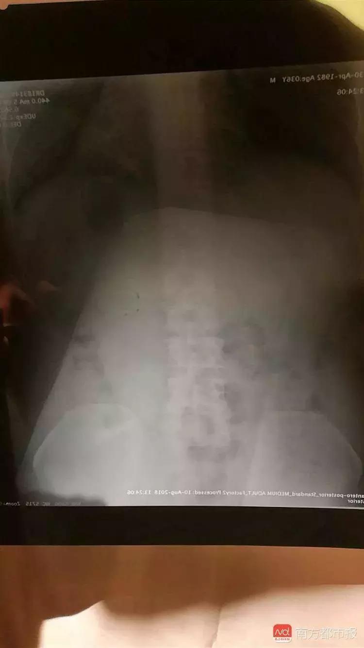 飞机餐吃出苍蝇怎么赔偿,飞机餐吃了食物中毒怎么索赔