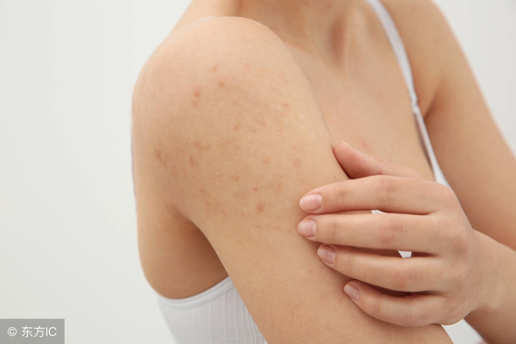 皮疹和湿疹有什么区别,皮疹和湿疹是怎么引起的