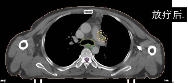 安罗替尼治小细胞肺癌吗,卡瑞利珠能治小细胞肺癌吗