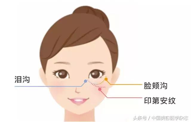 外眦悬吊固定视频操作方法,眼睑松弛矫正手术术前设计方案