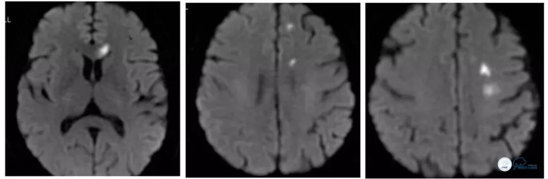 颈内动脉c5到c7段狭窄微创手术,天坛医院住院日记