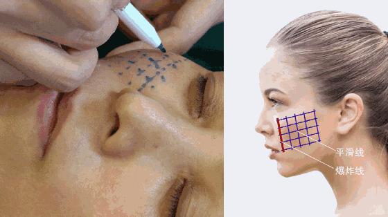 有法令纹很显老怎么办,法令纹木偶纹哪个显老