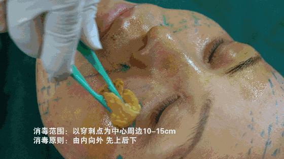 有法令纹很显老怎么办,法令纹木偶纹哪个显老