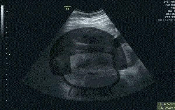 怀孕的搞笑b超图,怀孕了想睡觉表情包