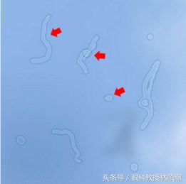 眼睛有飞蚊会导致视网膜脱落吗,有飞蚊症还闪光是视网膜脱落吗