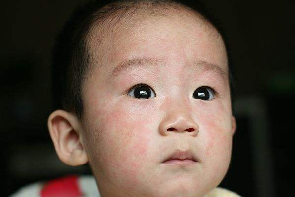 幼儿急疹治疗方法及护理,幼儿急疹需要注意的事项