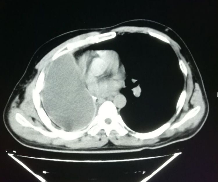 肺癌手术后胸腔内有碎肉怎么办,肺癌切除手术后有个空腔