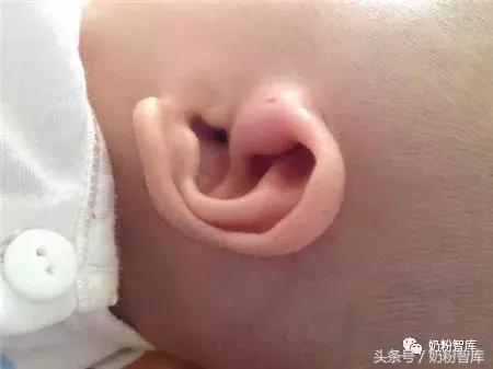 宝宝耳朵里小孔,宝宝耳朵上有个小孔怎么处理