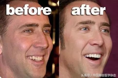 牙齿缝隙发黑怎么清洁,牙齿根部窄缝隙大怎么修补