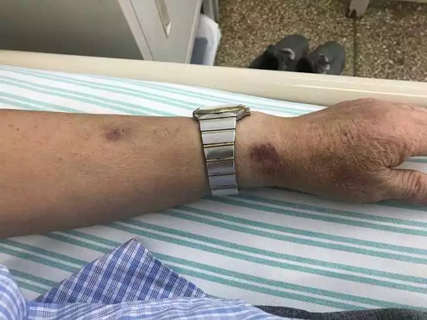 老人听信偏方乱投医吃错了药,大伯吃掉上百支皮炎平软膏