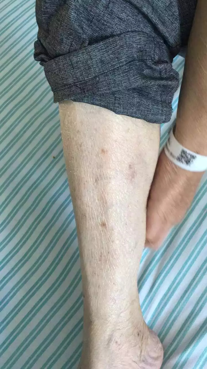 天呐！温州大伯吃掉上百支“皮炎平”软膏，医生一问都懵了