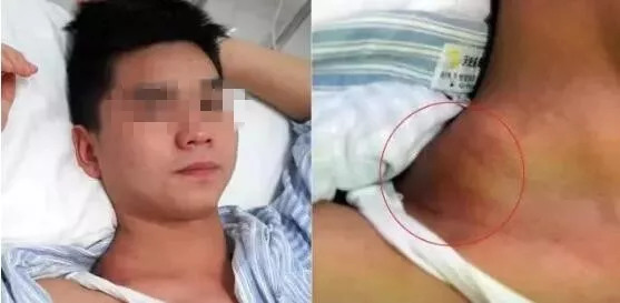 胎记也能要人命！20岁帅小伙“蝇子屎”胎记疯长鸡蛋大小，危在旦夕