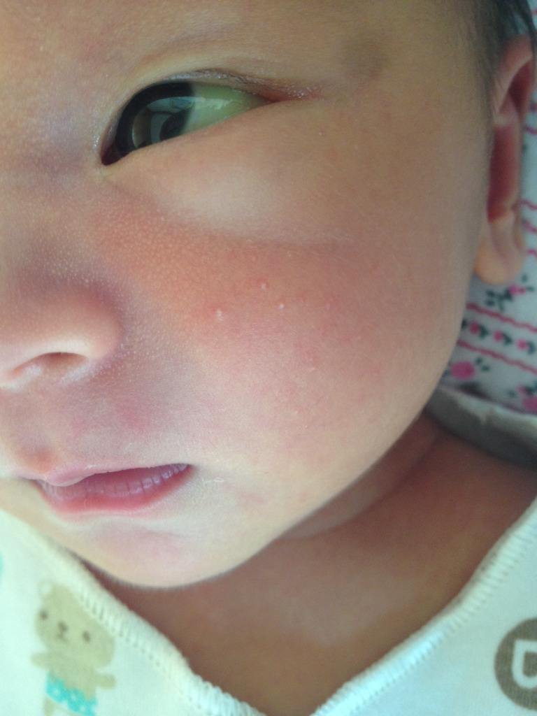 宝宝湿疹很痒光抓怎么帮宝宝缓解,宝宝湿疹痒有什么好办法