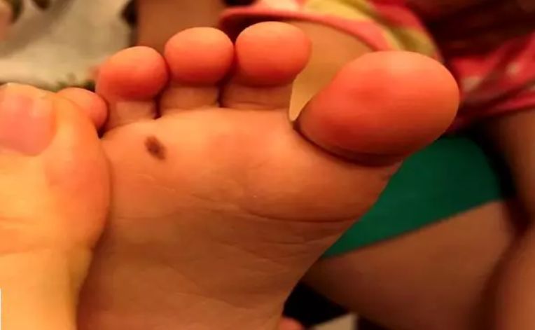 宝宝从小脚上就长黑痣是怎么回事,小孩脚后跟长了颗黑痣越来越大